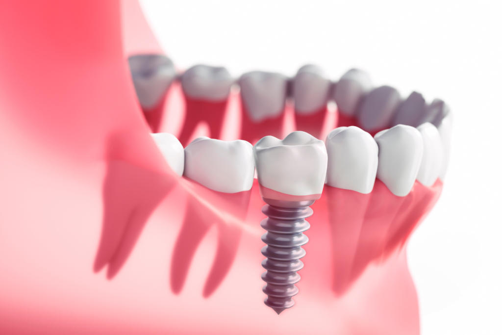 dental implants near st albans