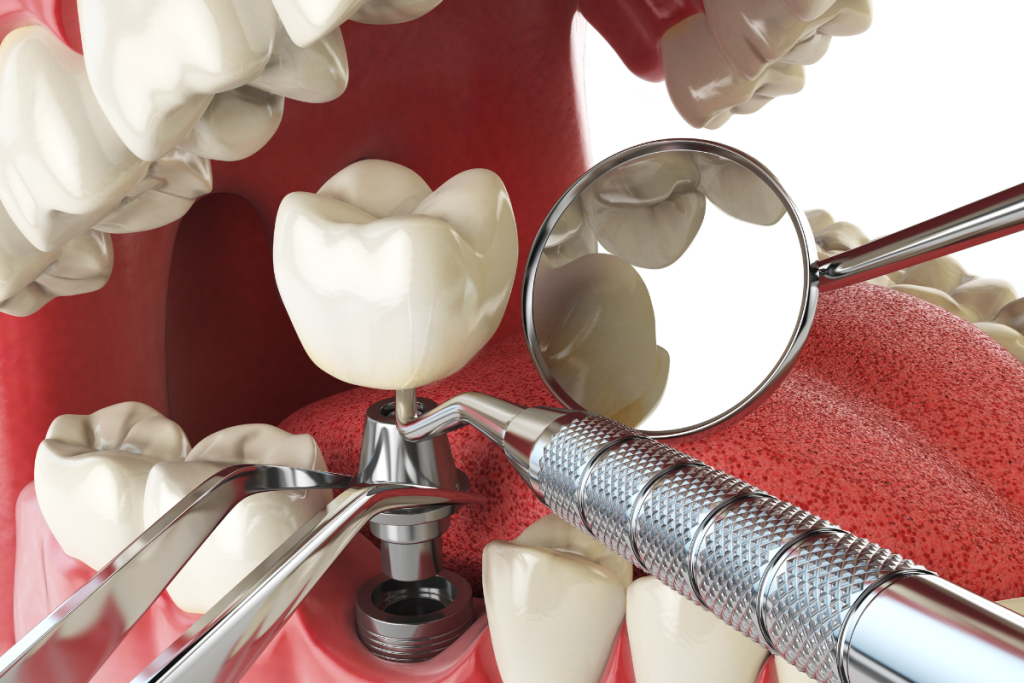dental implants image