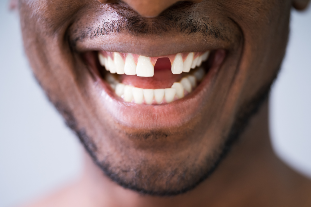 dental implants near st albans