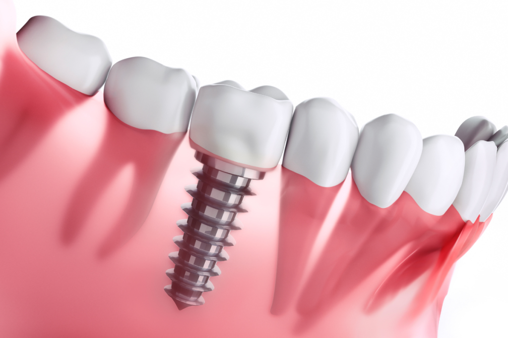 dental implants near st albans