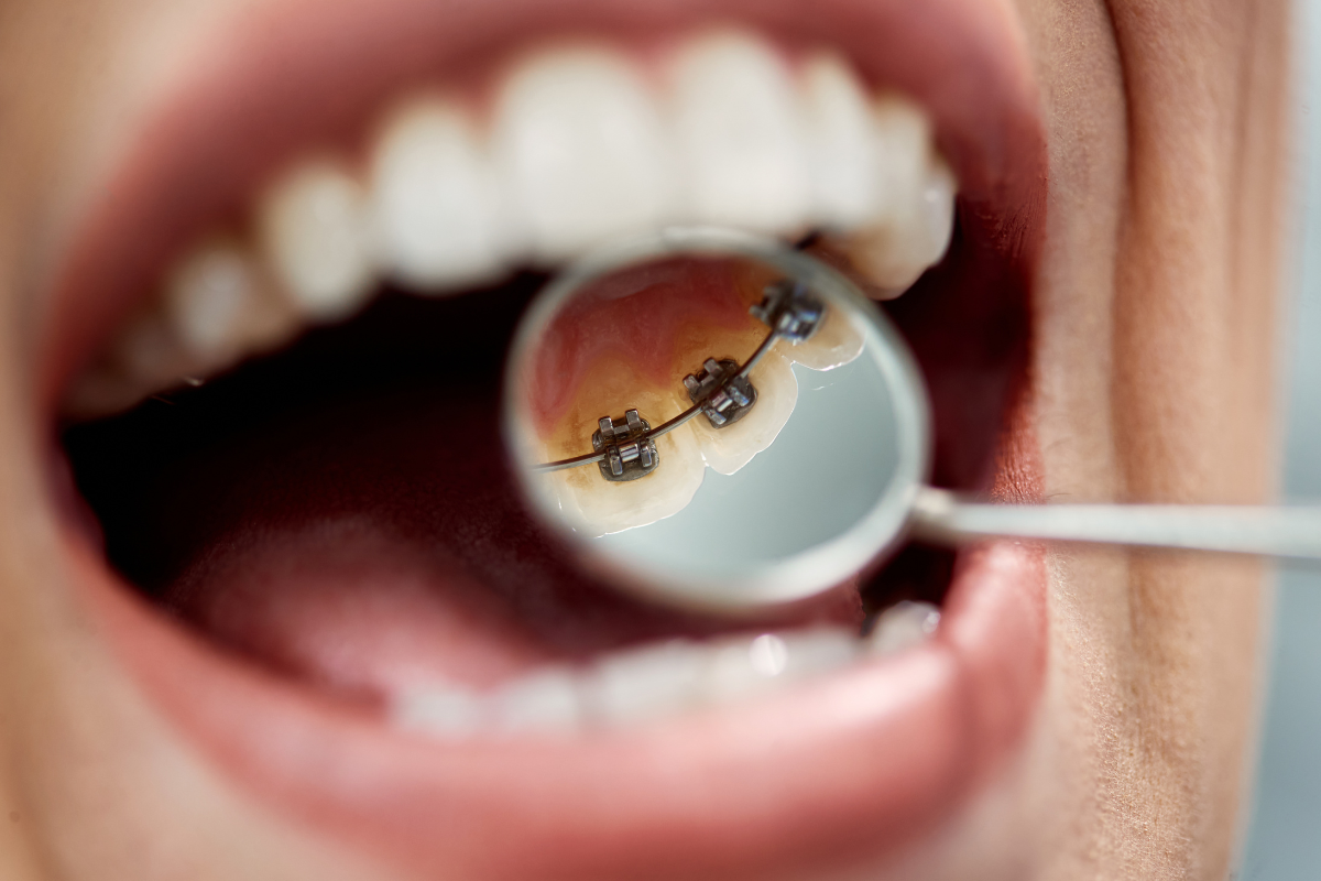 orthodontist near st albans