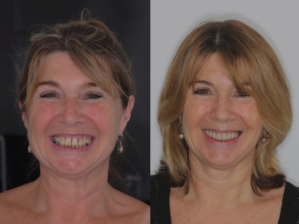 UKDS - Dental Implants at UK Dental Specialists